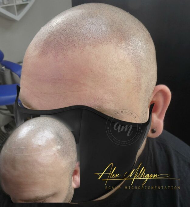 Before After scalp micropigmentation scalp tattoo bournemouth