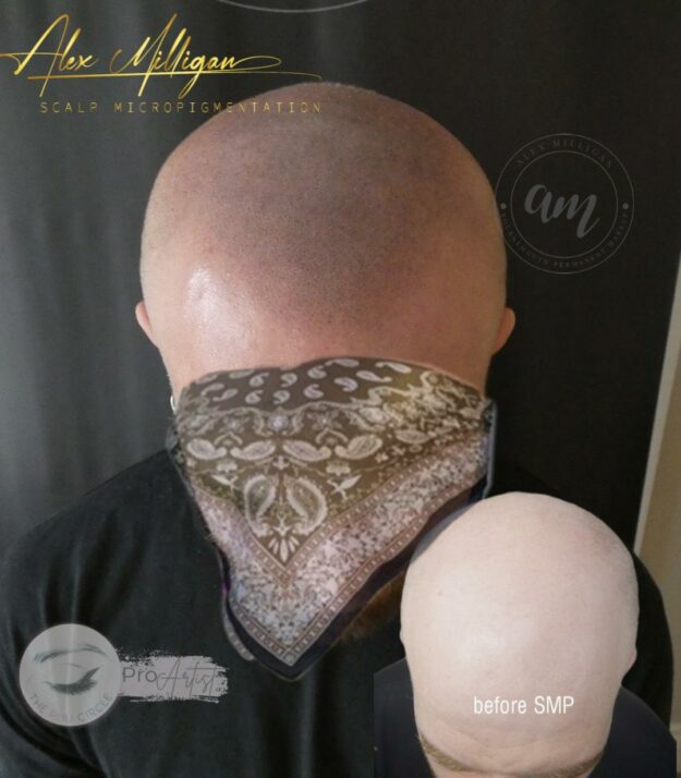 Scalp Tattoo Bournemouth - SCALP TATTOO BEFORE AFTER BY Alex Milligan