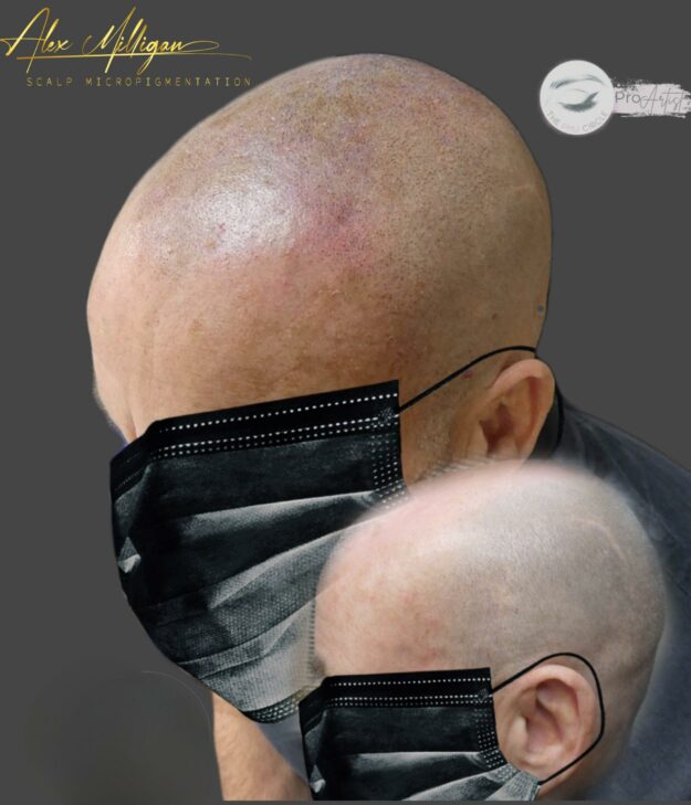 SMP Scalp Tattoo Bournemouth