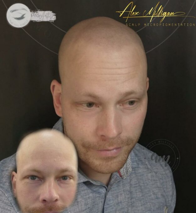 Scalp Tattoo Bournemouth - SMP before after Alex Milligan