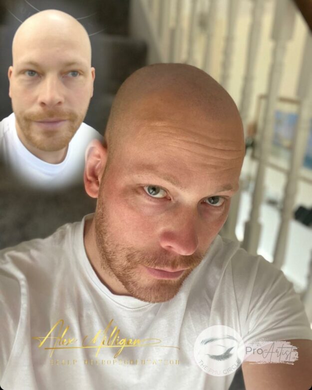 Scalp Tattoo Bournemouth - SMP scalp tattoo bournemouth before after