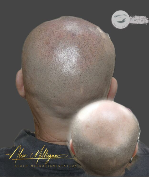 Scalp Tattoo Bournemouth - scalp tattoo back of head Alex Milligan