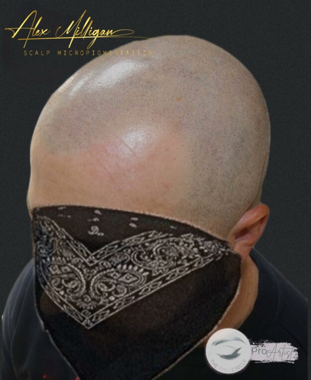 Scalp Tattoo Bournemouth - scalp tattoo smp